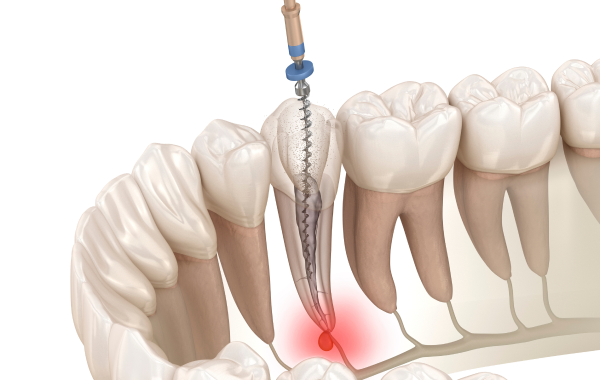 endodontie infection pulpaire paris racine Retraitement endodontique Dentiste Dr Attuil Régis | Endodontie à Paris 17