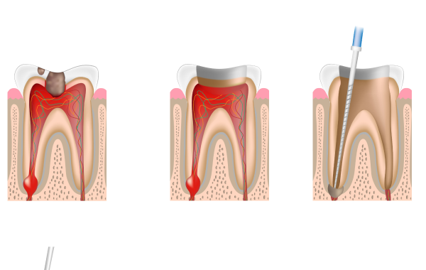 infection pulpaire paris consultation Endodontie chirurgicale Dentiste Dr Attuil Régis | Endodontie à Paris 17