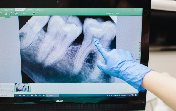 infection pulpaire paris racine Retraitement endodontique Dentiste Dr Attuil Régis | Endodontie à Paris 17