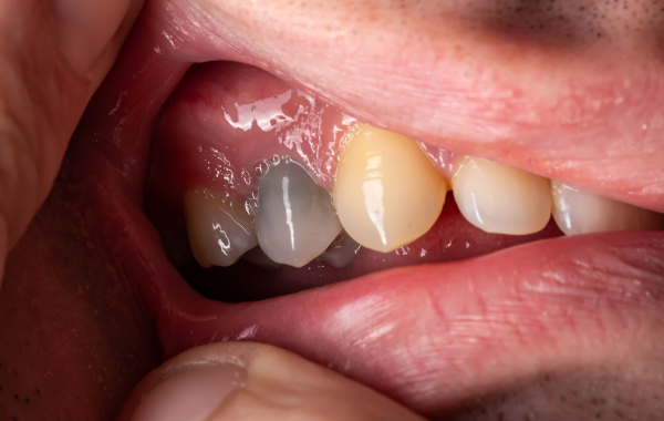 infection pulpaire paris soins endodontie Traitement de nécrose Dentiste Dr Attuil Régis | Endodontie à Paris 17