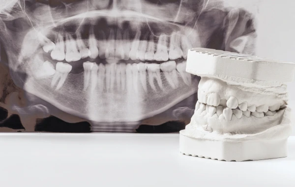 infection pulpaire paris soins profonds Traitement des traumatismes Dentiste Dr Attuil Régis | Endodontie à Paris 17