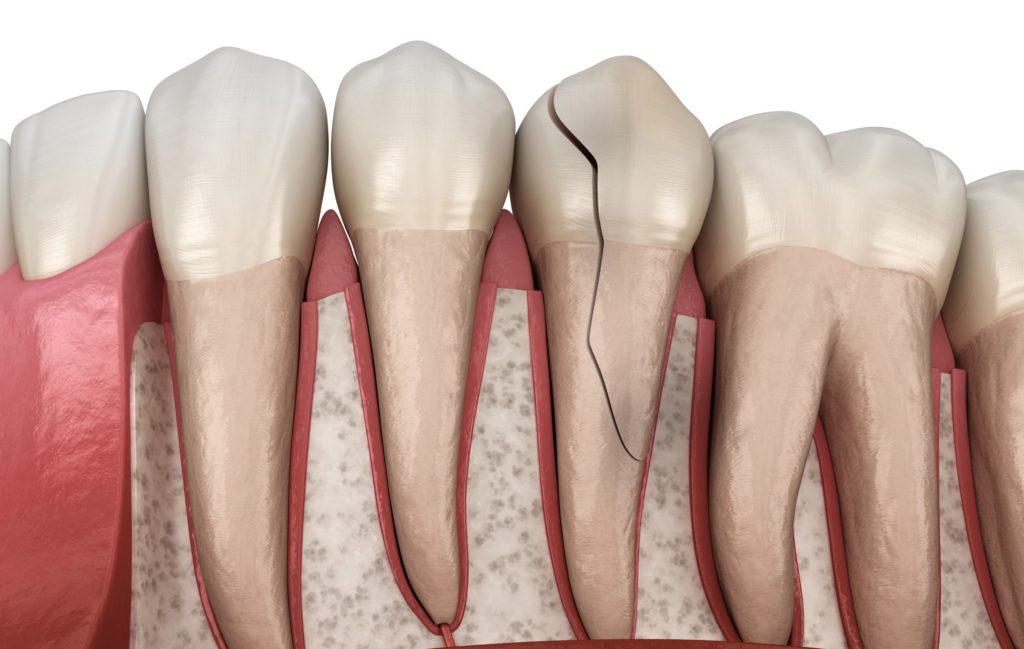 retraitement endodontique paris traitement Traitement des traumatismes Dentiste Dr Attuil Régis | Endodontie à Paris 17