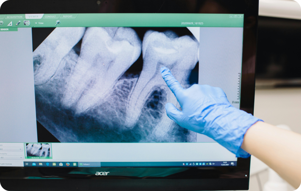 Traitement de racine à Paris 17 Dentiste Dr Attuil Régis | Endodontie à Paris 17