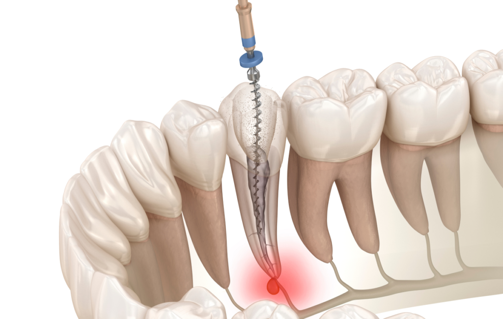 Endodontiste à Paris 17 Dentiste Dr Attuil Régis | Endodontie à Paris 17