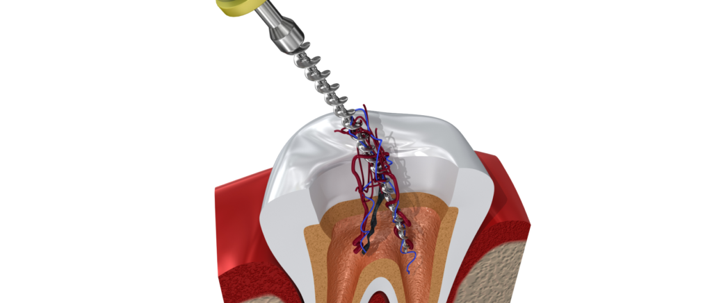 Endodontiste à Paris 17 Dentiste Dr Attuil Régis | Endodontie à Paris 17
